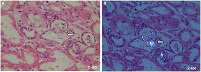 Case report: Acute <mark class="highlighted">oxalate</mark> nephropathy due to traditional medicinal herbs
